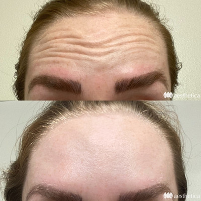 Dysport Utah | Aesthetica Medical Spa