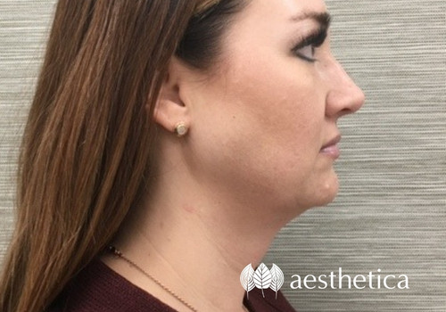 kybella before and after photo
