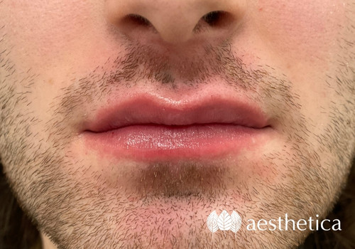 male lip injections utah