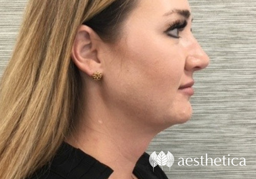 kybella before and after photo