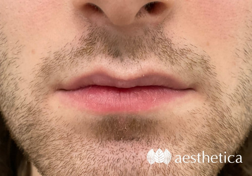 male lip injections before