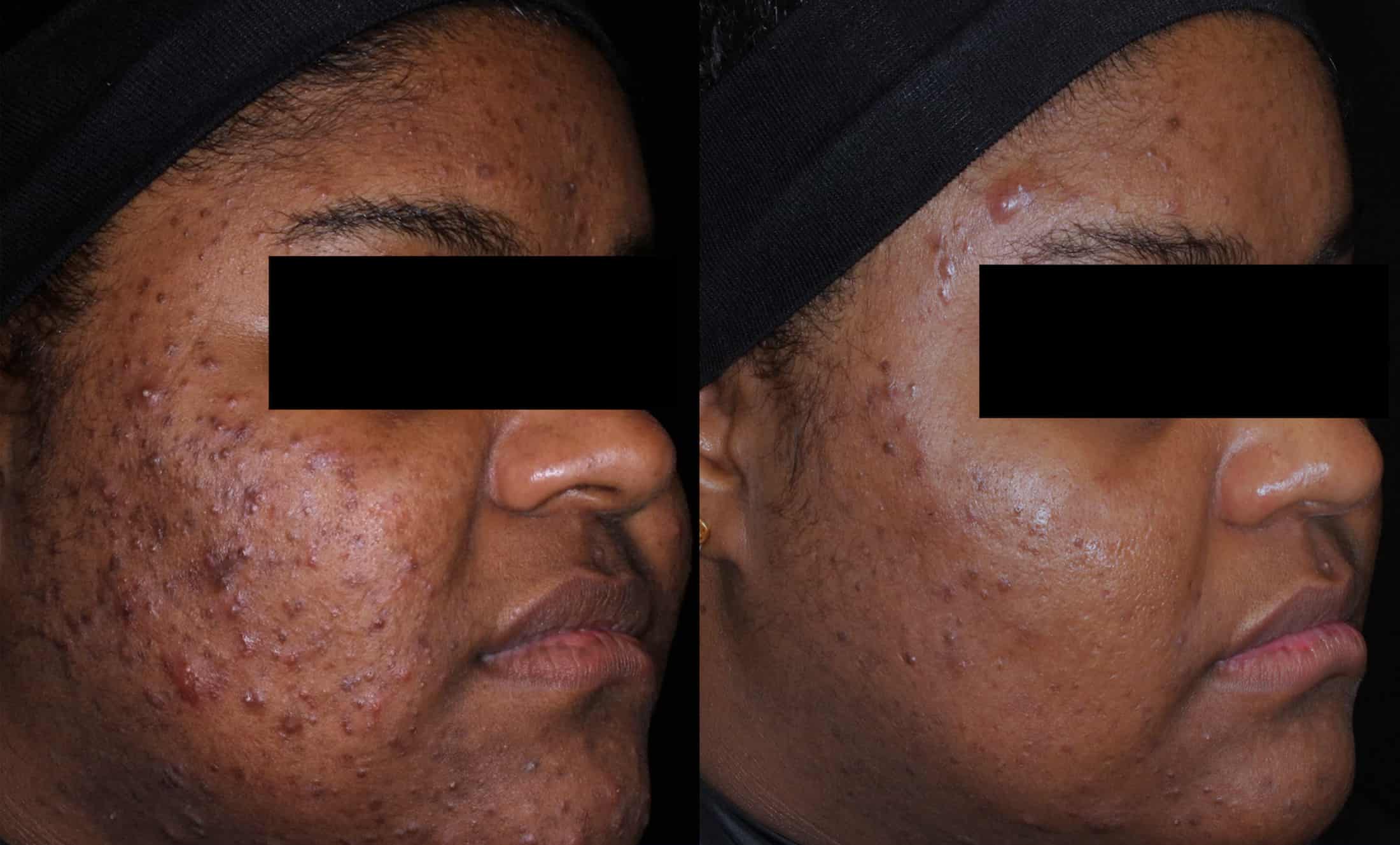aviclear laser utah