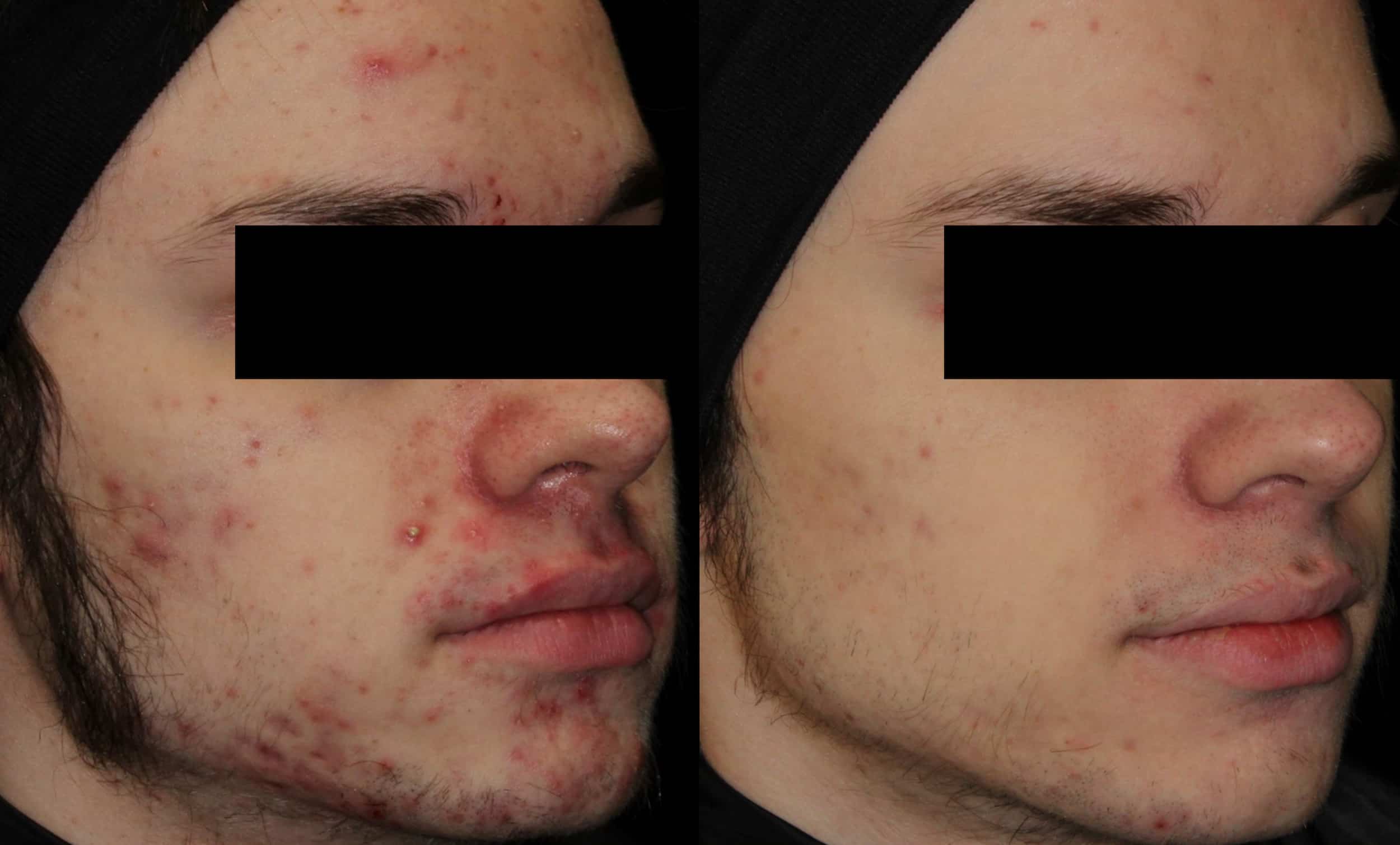aviclear laser