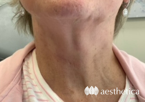 radiesse neck after