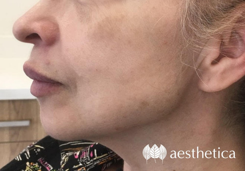 dec-22-special-skin-rejuvenation-treatments skin treatment special utah