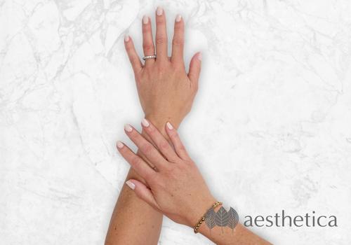 dermal filler for hands after