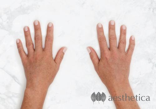 restylane hands after