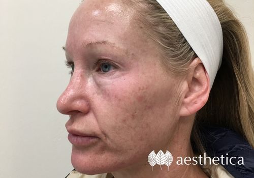 IPL laser after