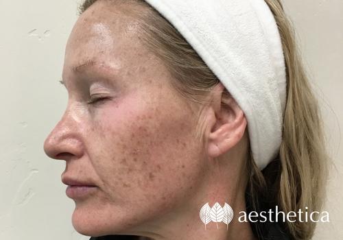IPL laser before