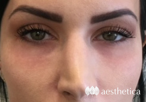 under eye filler after