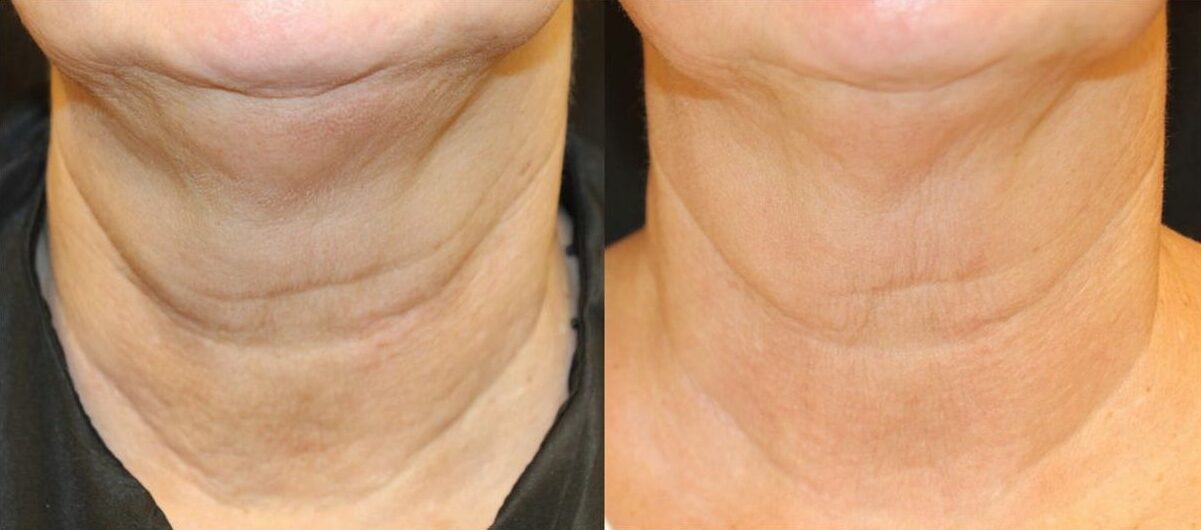 opus plasma laser before and after