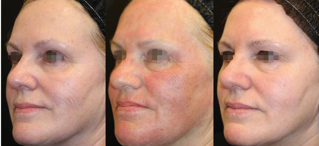 opus plasma treatment utah