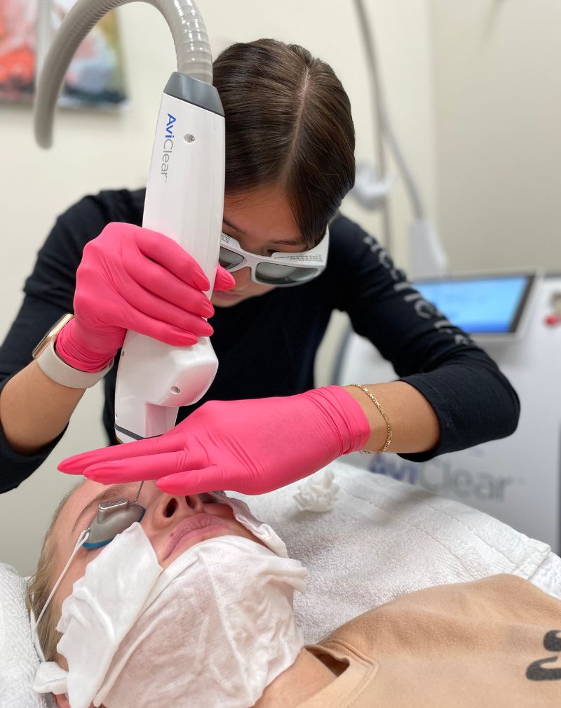 AviClear laser acne treatment