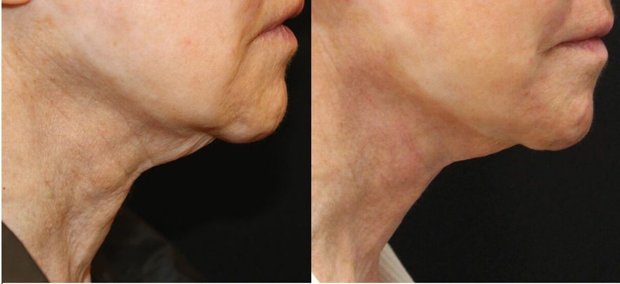 opus plasma laser utah