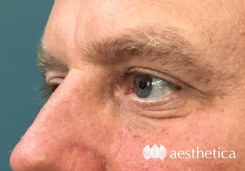 male under eye filler
