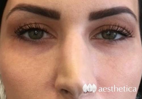under eye filler before