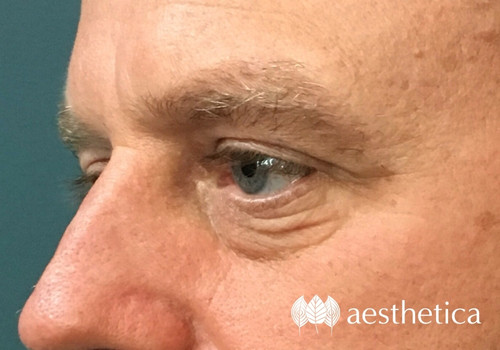 under eye filler before and after on a man