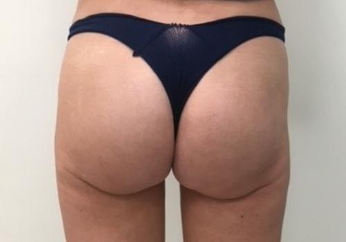 sculptra butt lift after