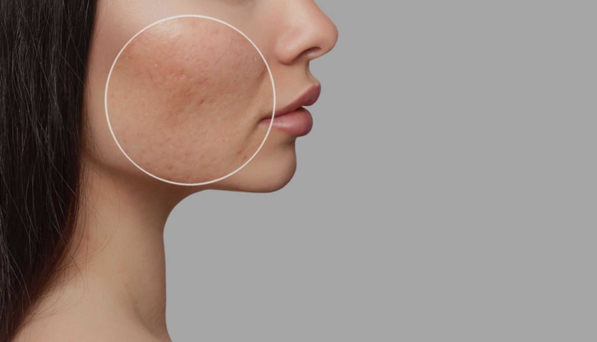 exceed microneedling at aesthetica now