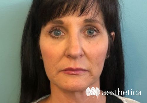profound rf microneedling before and after