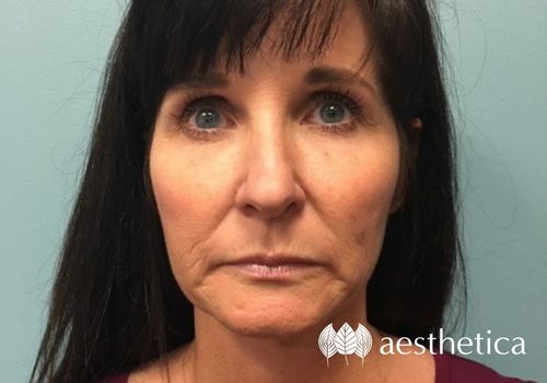 profound rf microneedling before and after
