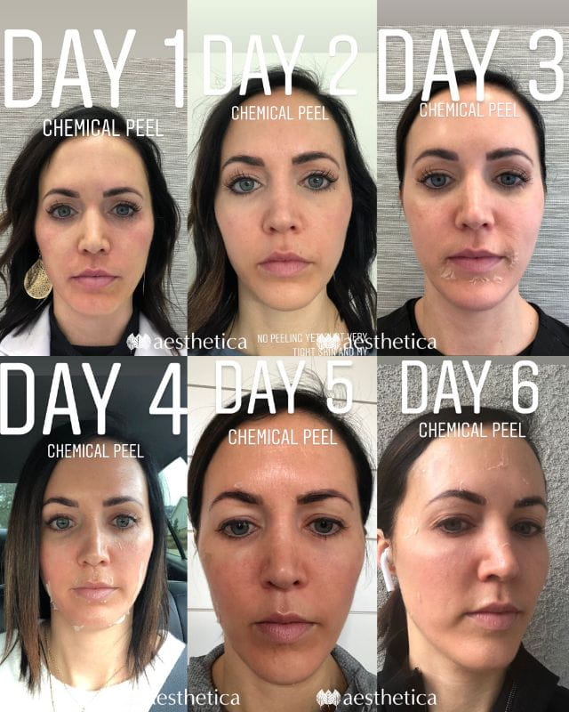 Chemical Peels Utah Aesthetica Medical Spa