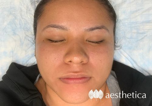 microneedling utah