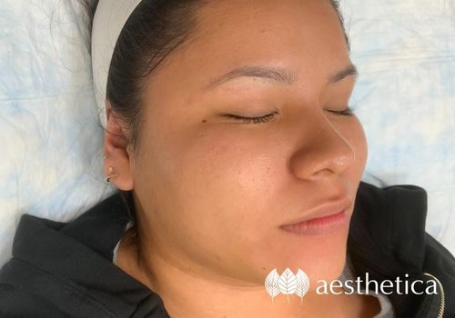 microneedling utah