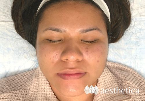 microneedling before and after