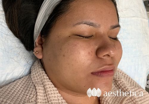 microneedling before and after