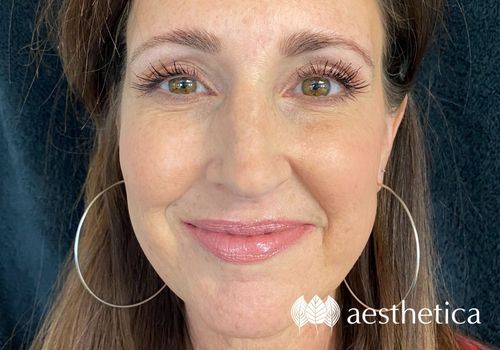 profound rf microneedling before and after