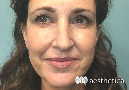 profound rf microneedling before and after