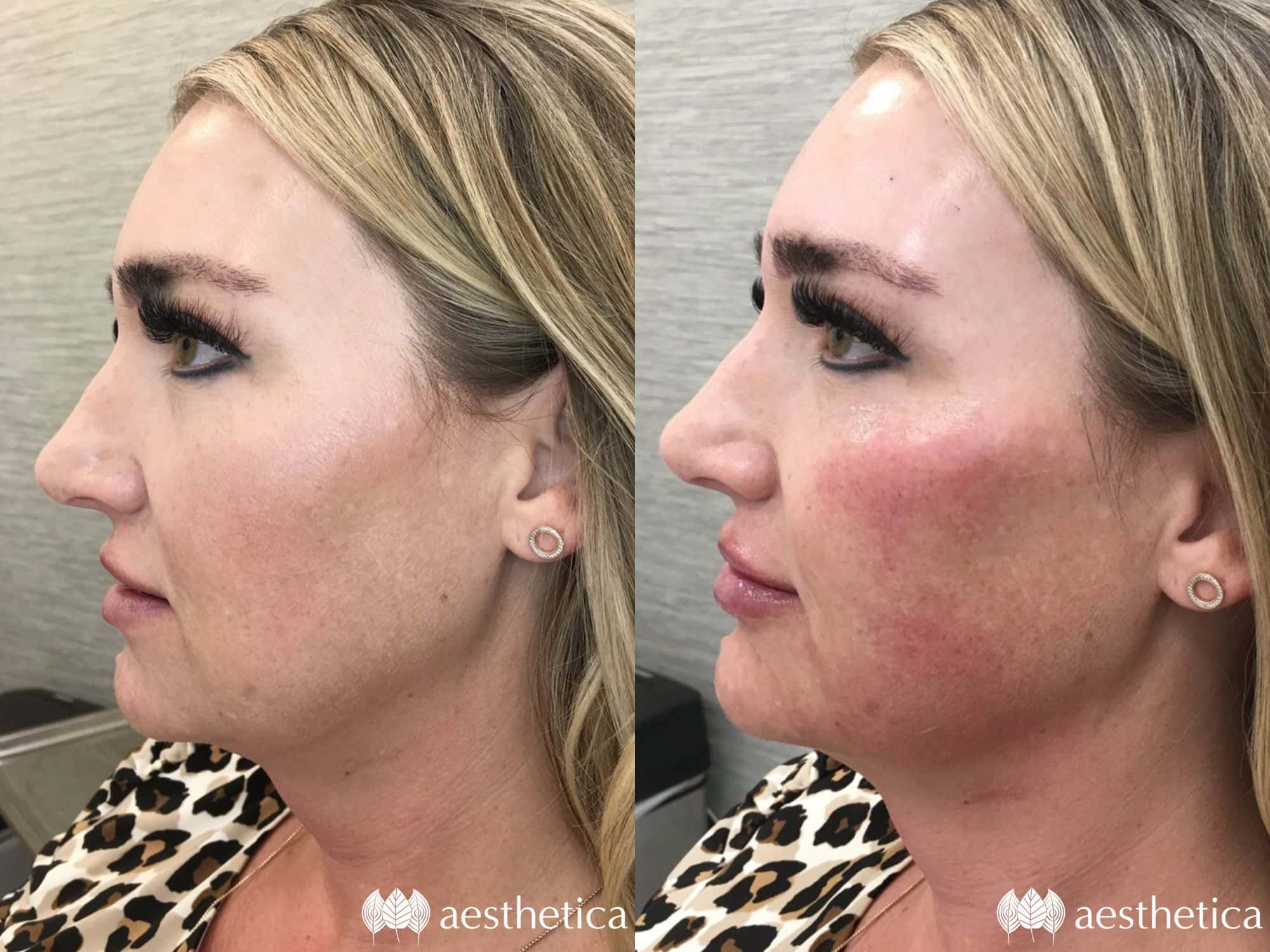 cheek filler before and after