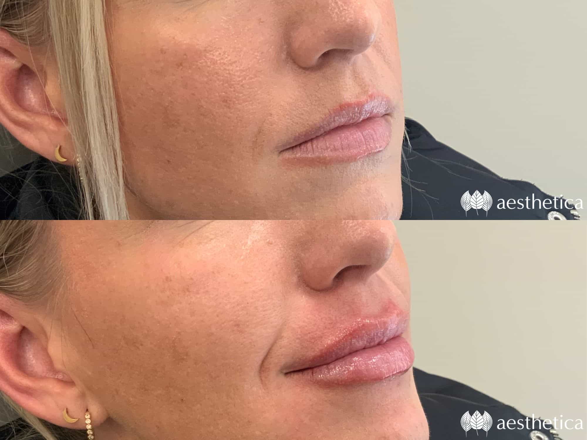 lip filler before and after