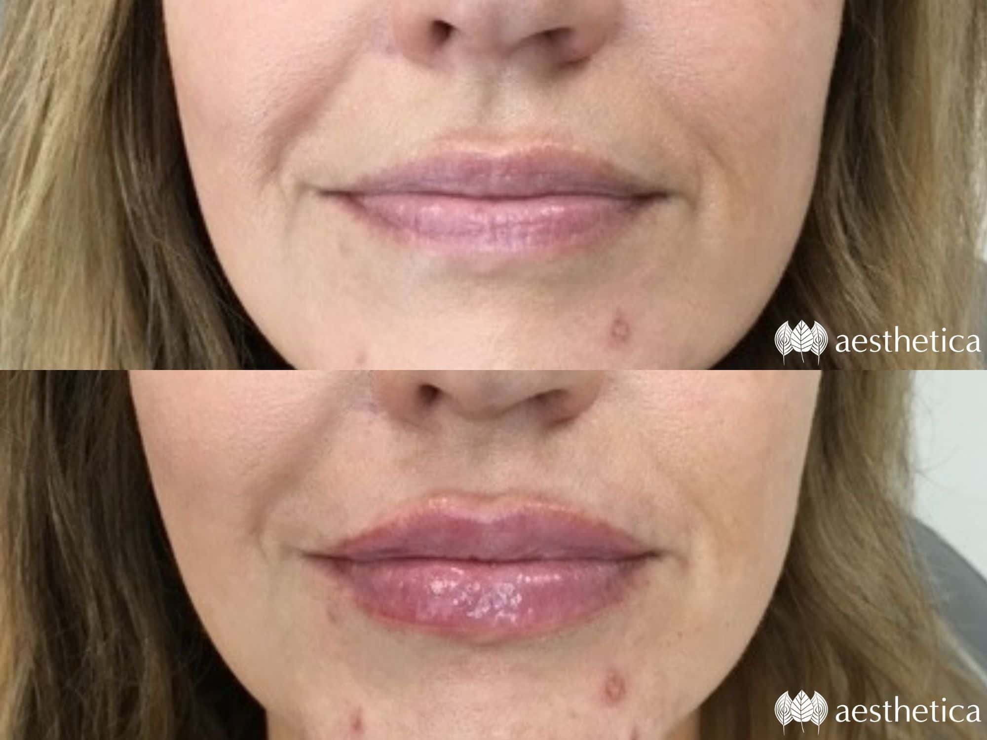 lip injection before and after