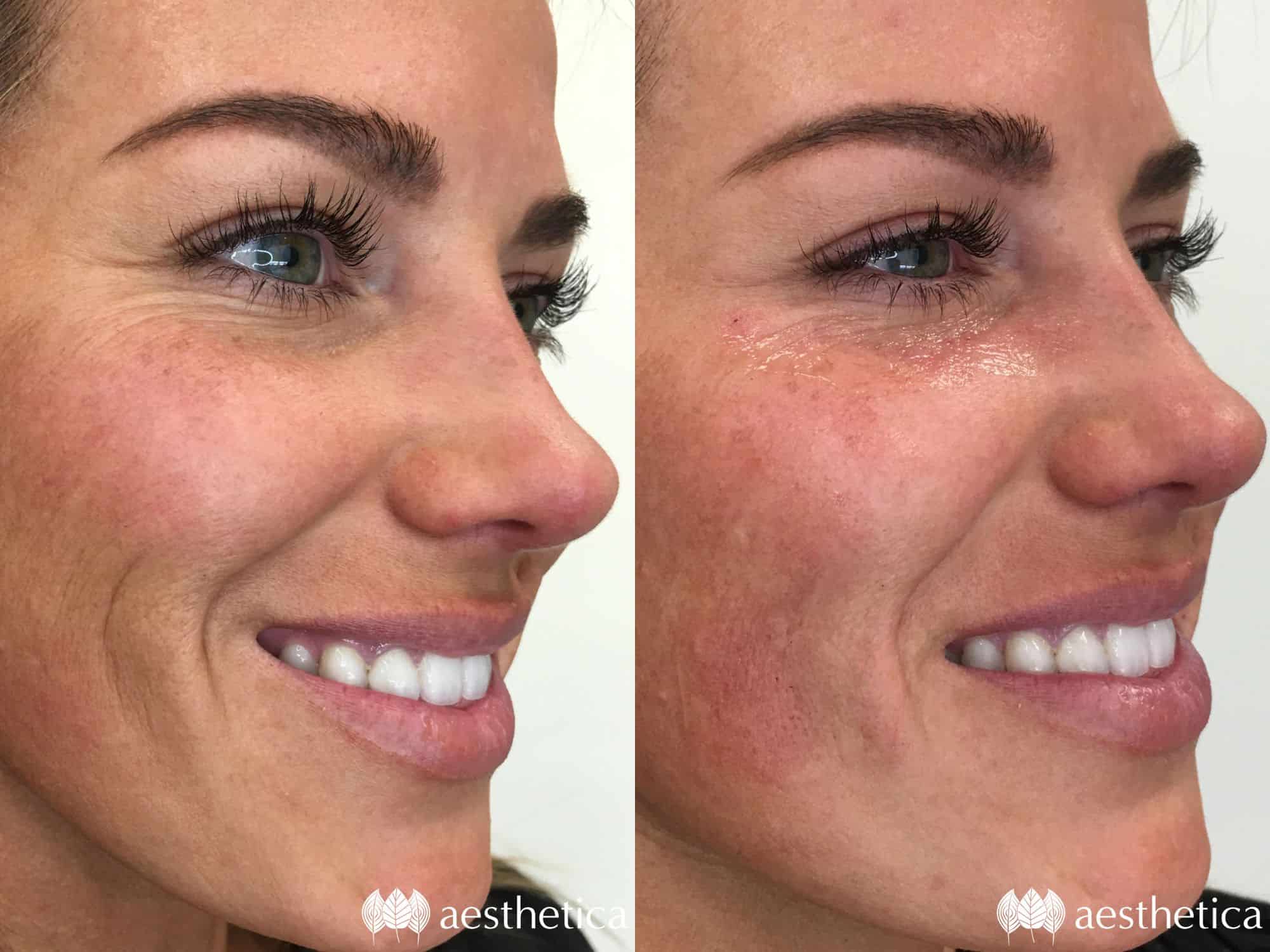 mouth lines filler before and after