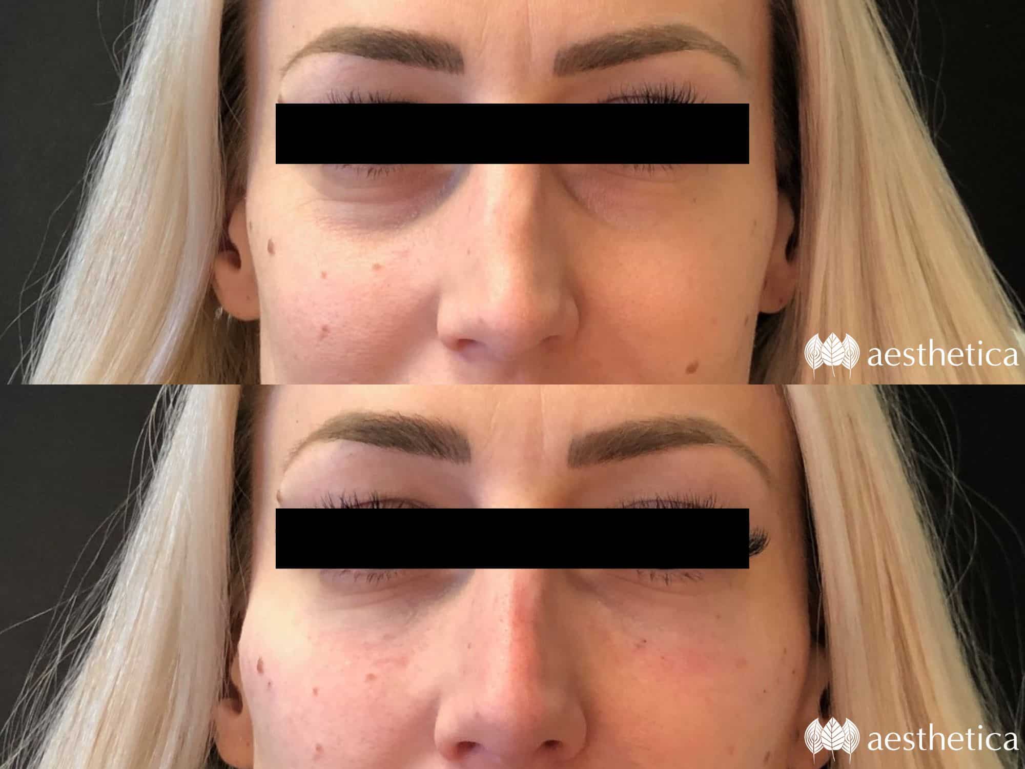 under eye filler before and after