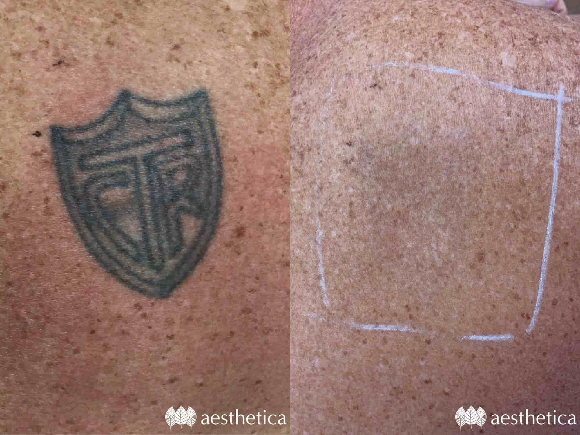 Laser-tattoo-removal-april-min