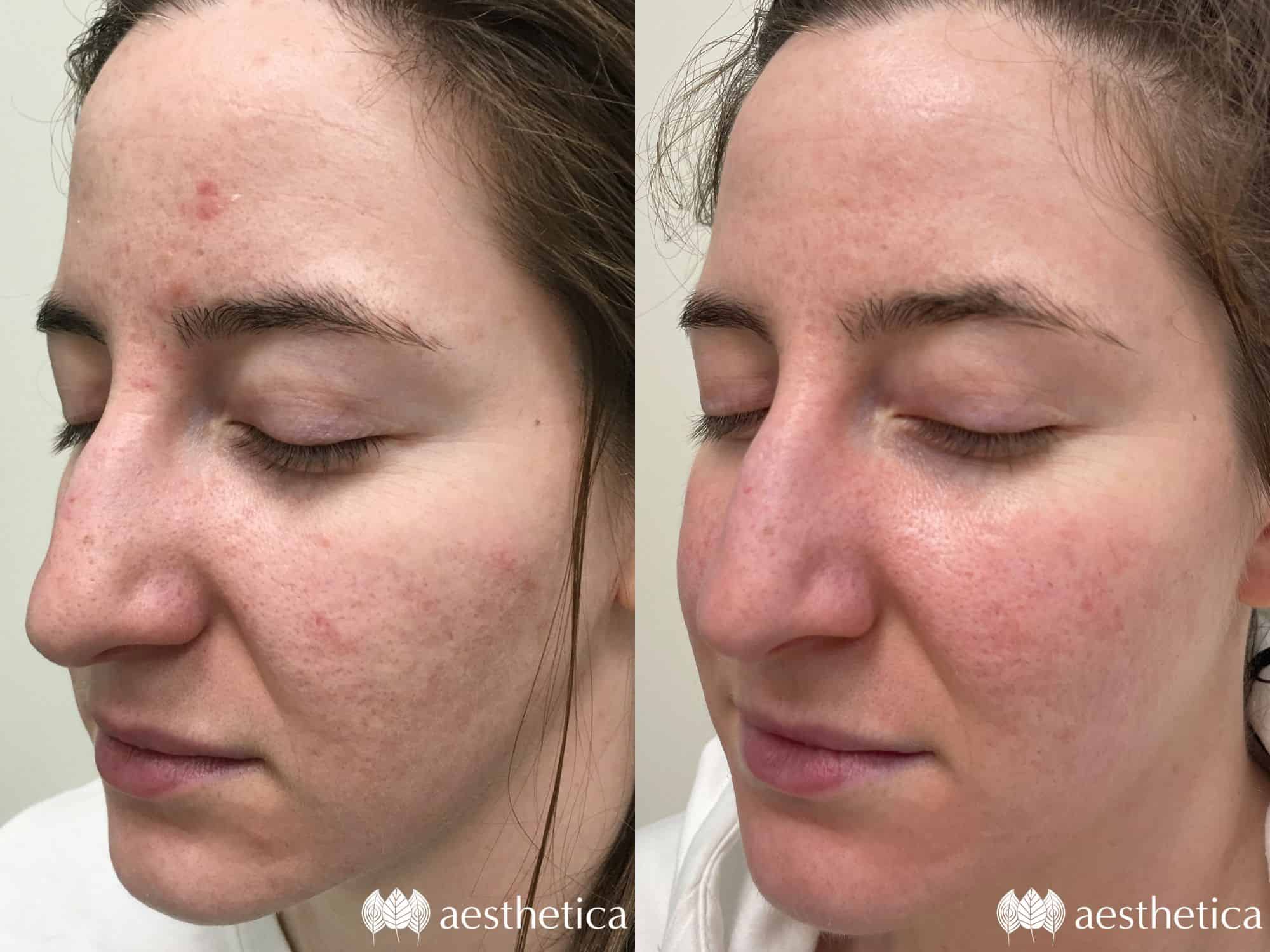 acne-patient-april-min