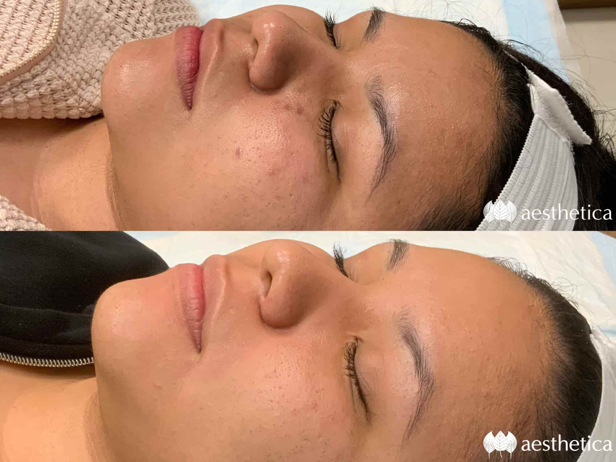 chemical-peel-by-april-min