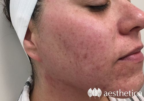 acne scar treatment utah