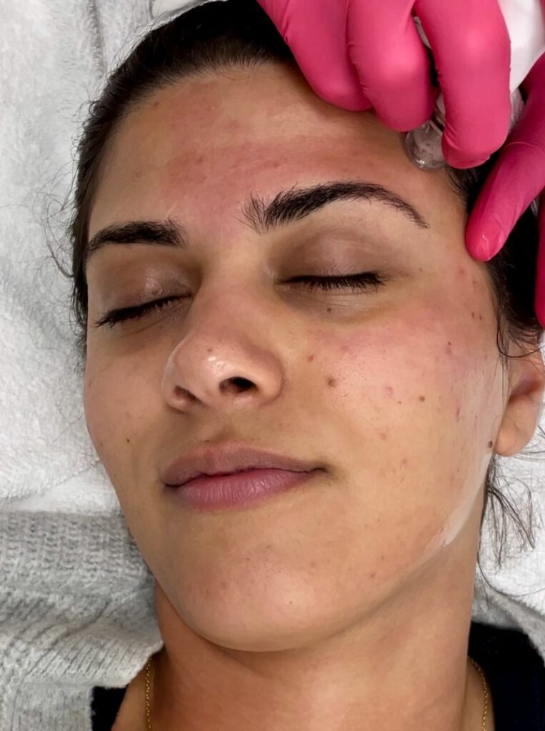 diamondglow facial for acne