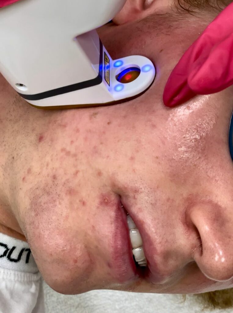 aviclear acne laser