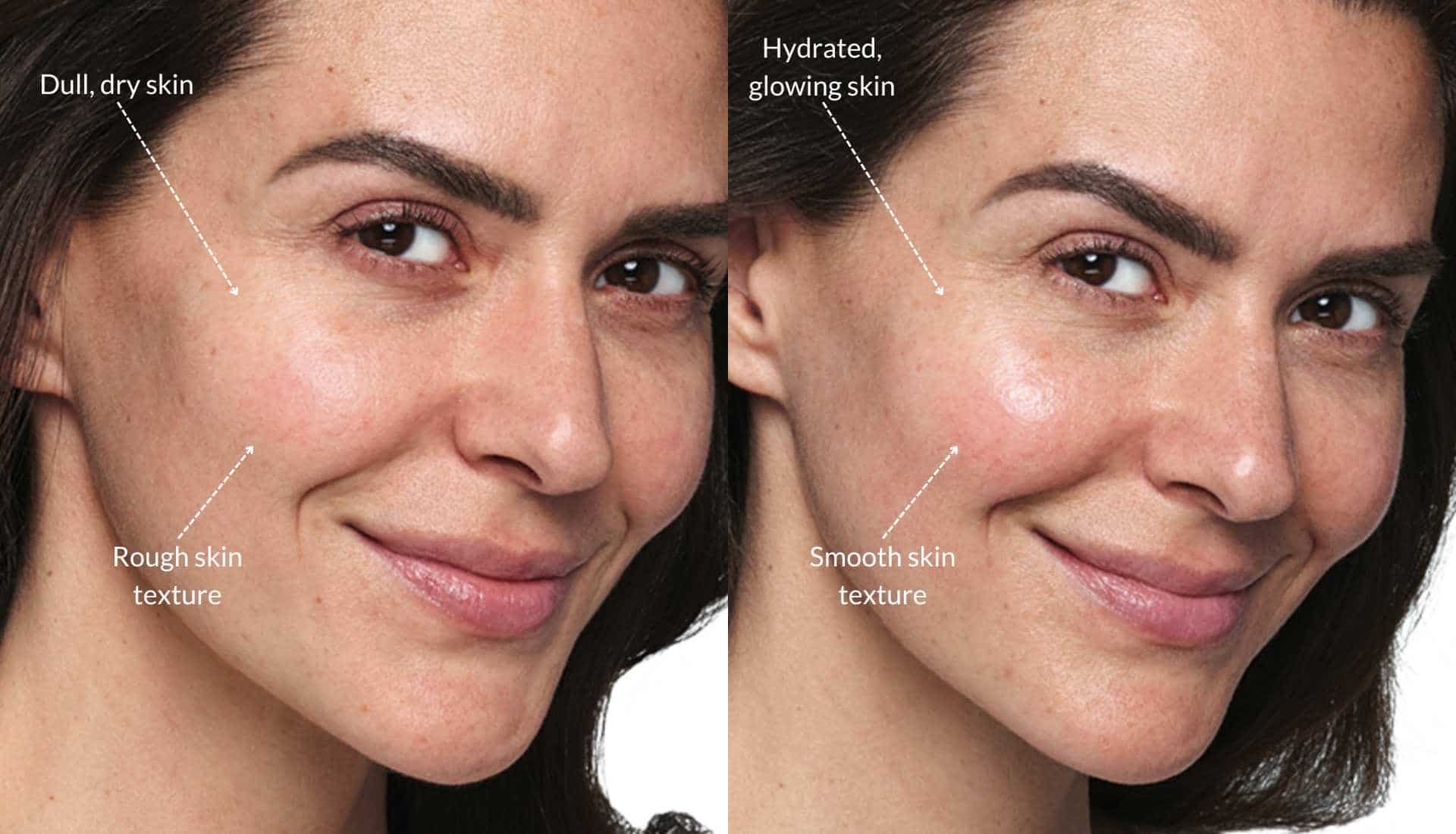 Skinvive juvederm