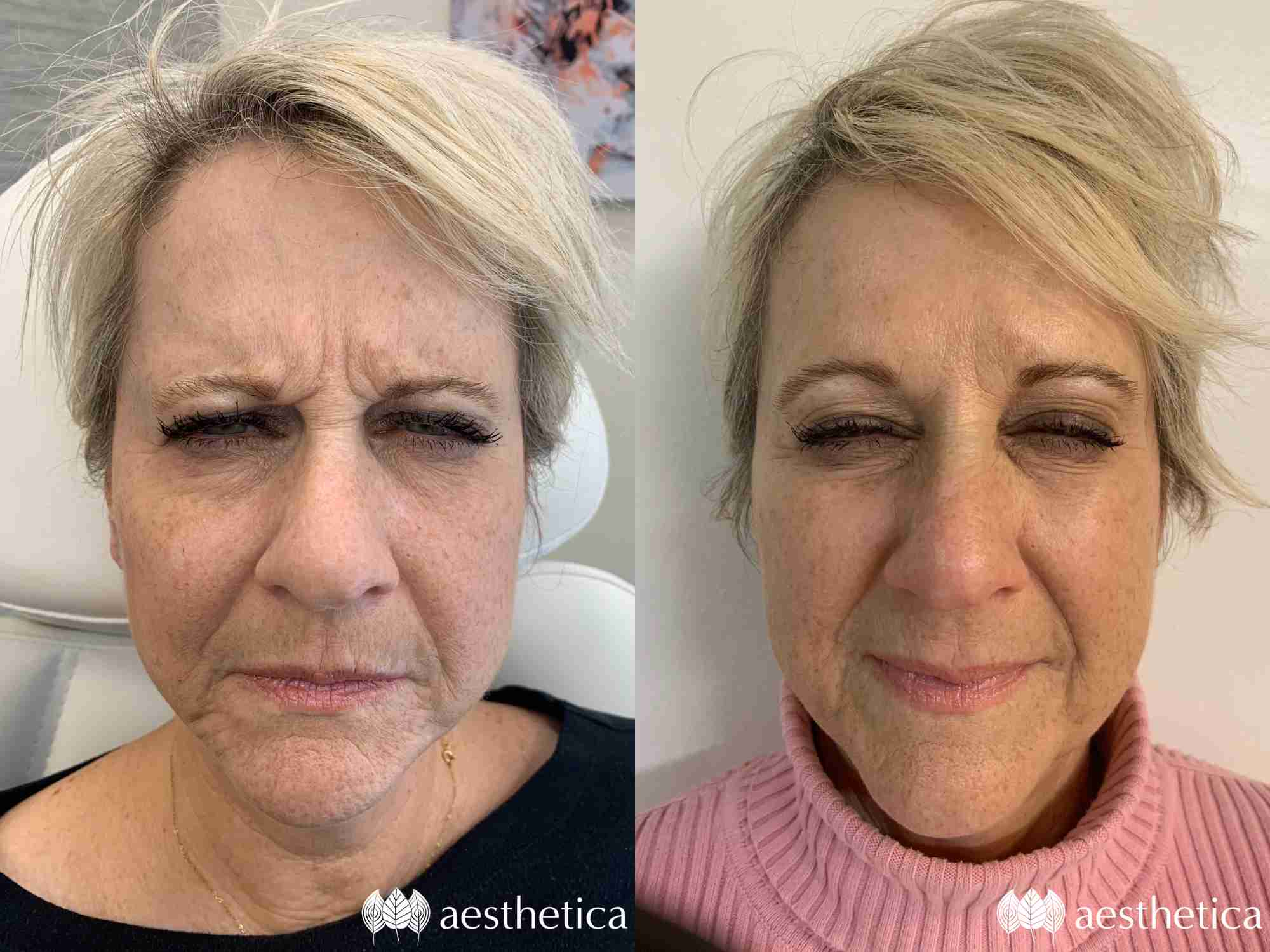 older patient botox