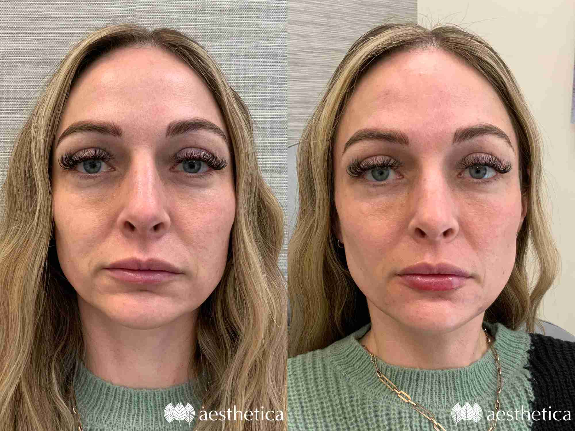 full face rejuvenation utah