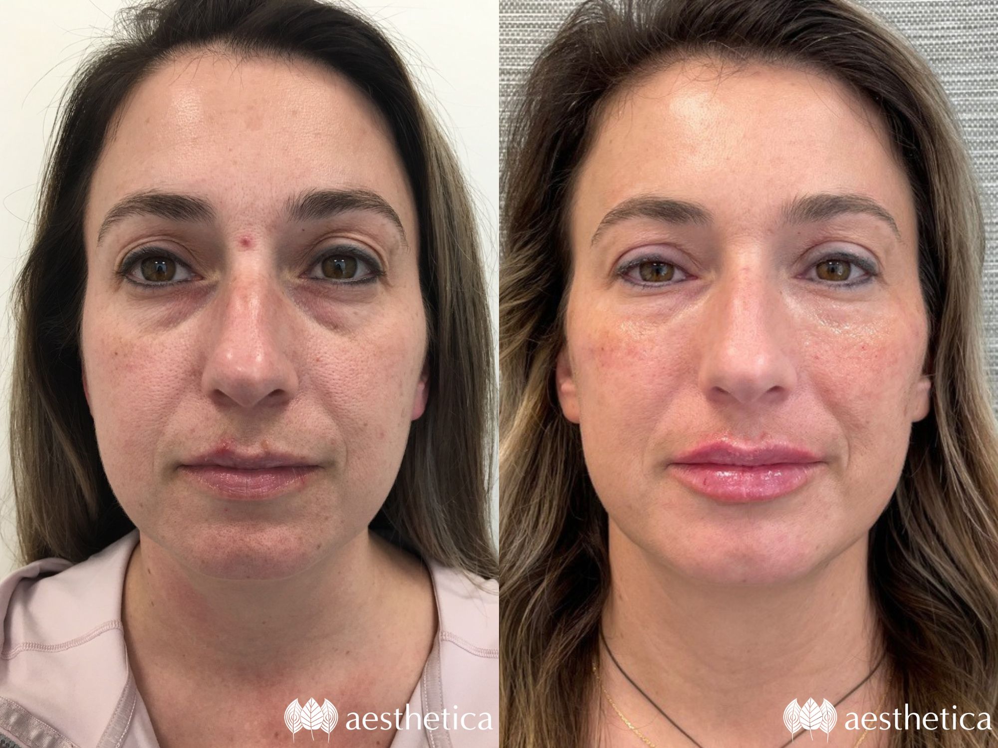 full-face-rejuvenation-by-steph