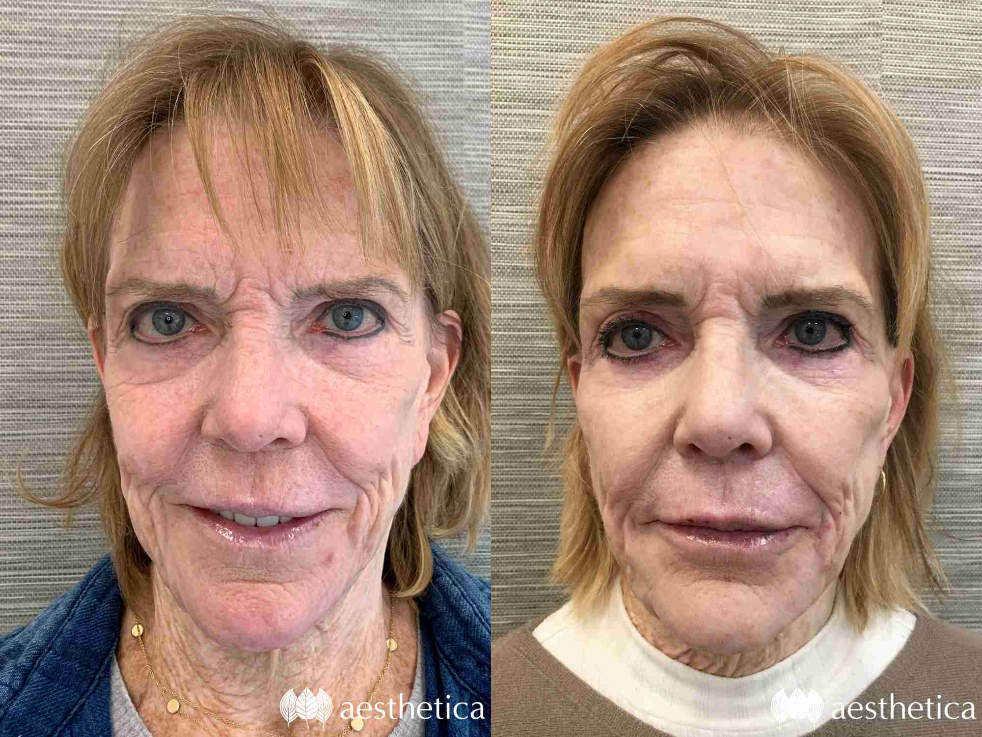 full face rejuvenation