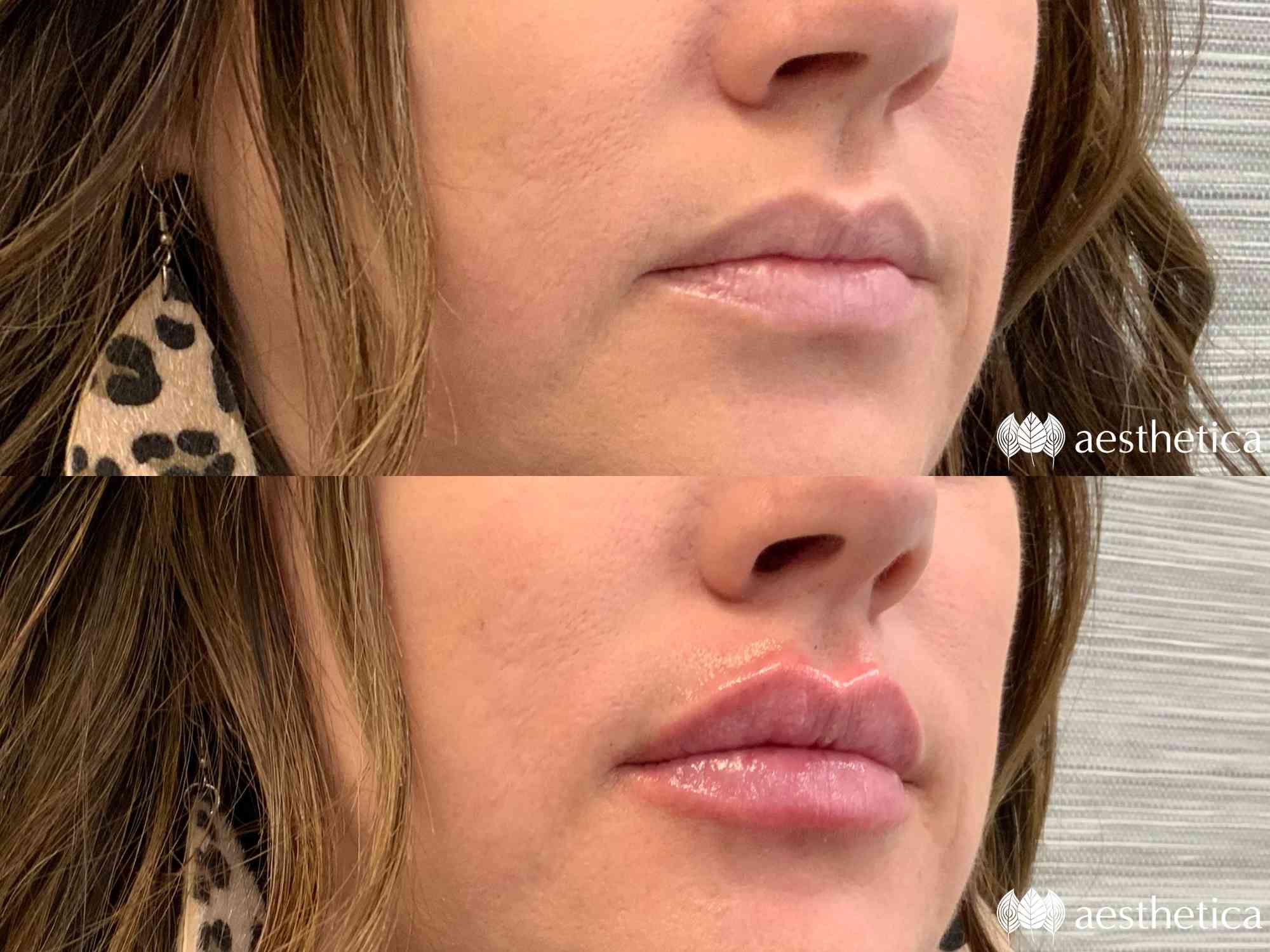 juvederm lip filler