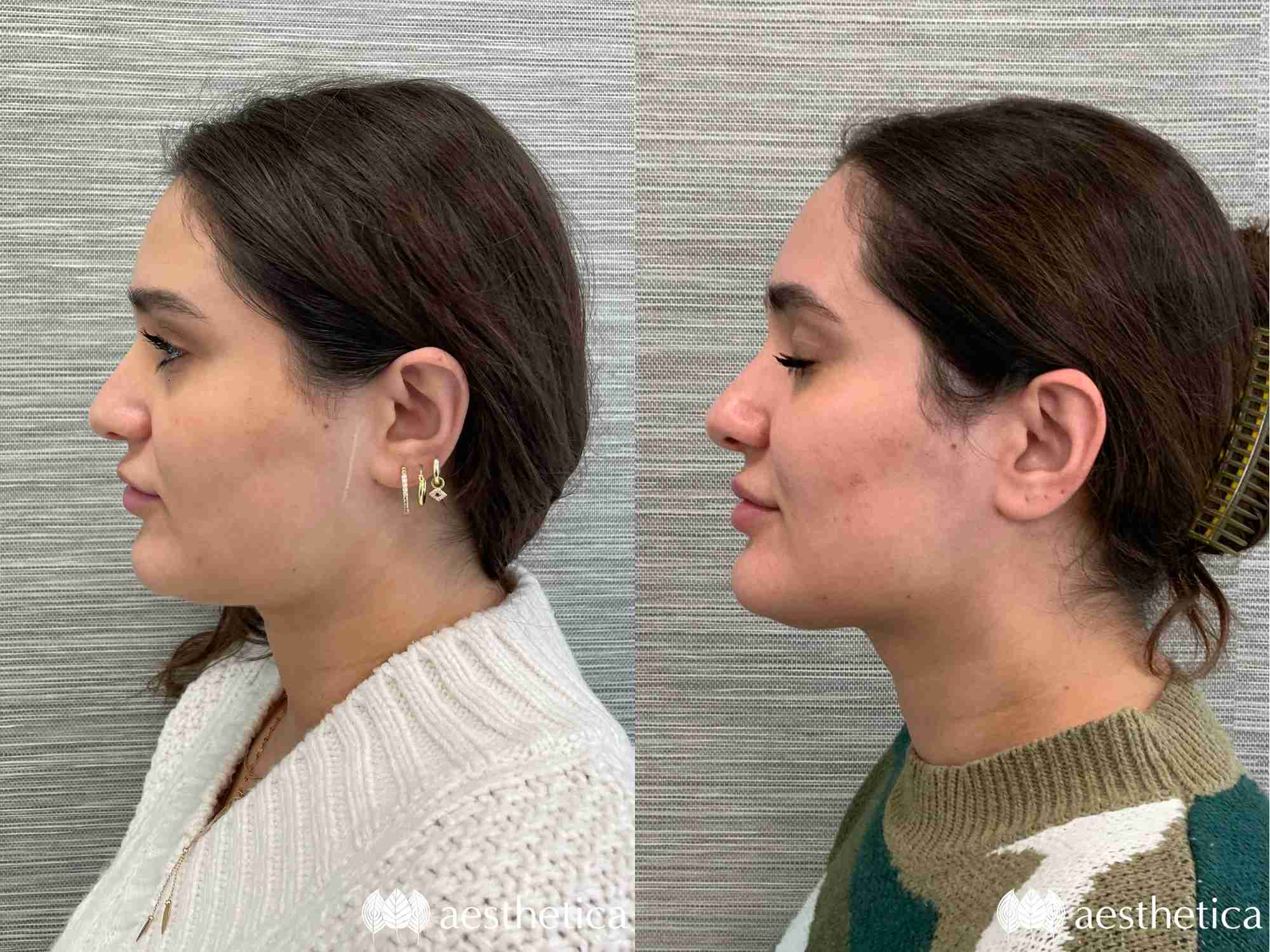 kybella utah